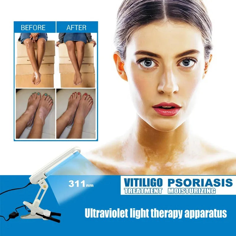 Handheld 311nm UVB Phototherapy Lamp for Skin Treatment and Care