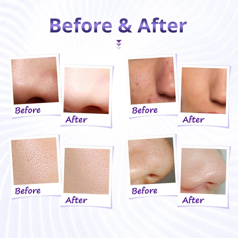 Diamond Tip Dermabrasion Facial Machine with Water Spray & Acne Removal