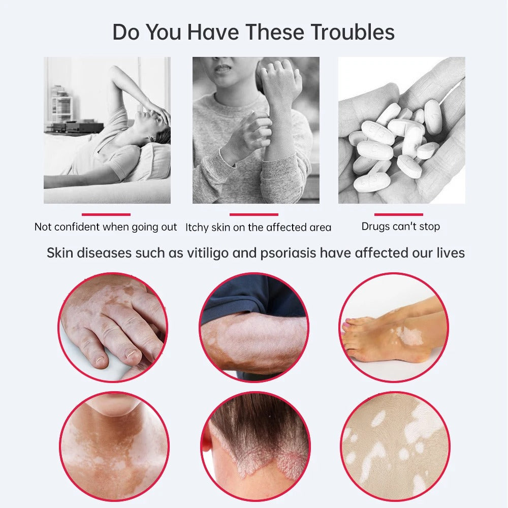 Handheld 311nm UVB Phototherapy Lamp for Skin Treatment and Care